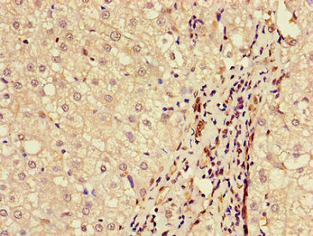 Immunohistochemistry of paraffin-embedded human liver cancer using CSB-PA613484LA01HU at dilution of 1:100