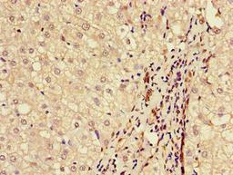 Immunohistochemistry of paraffin-embedded human liver cancer using CSB-PA613484LA01HU at dilution of 1:100