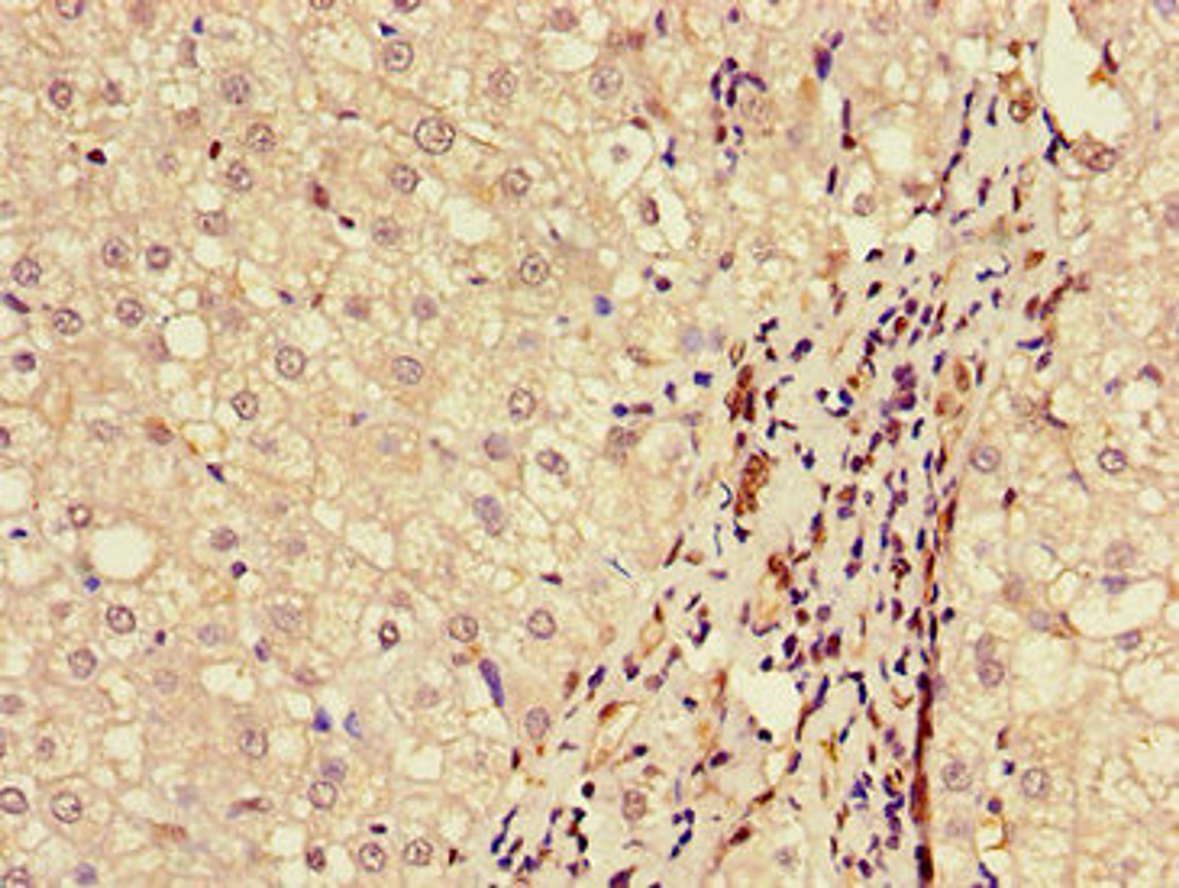 Immunohistochemistry of paraffin-embedded human liver cancer using CSB-PA613484LA01HU at dilution of 1:100