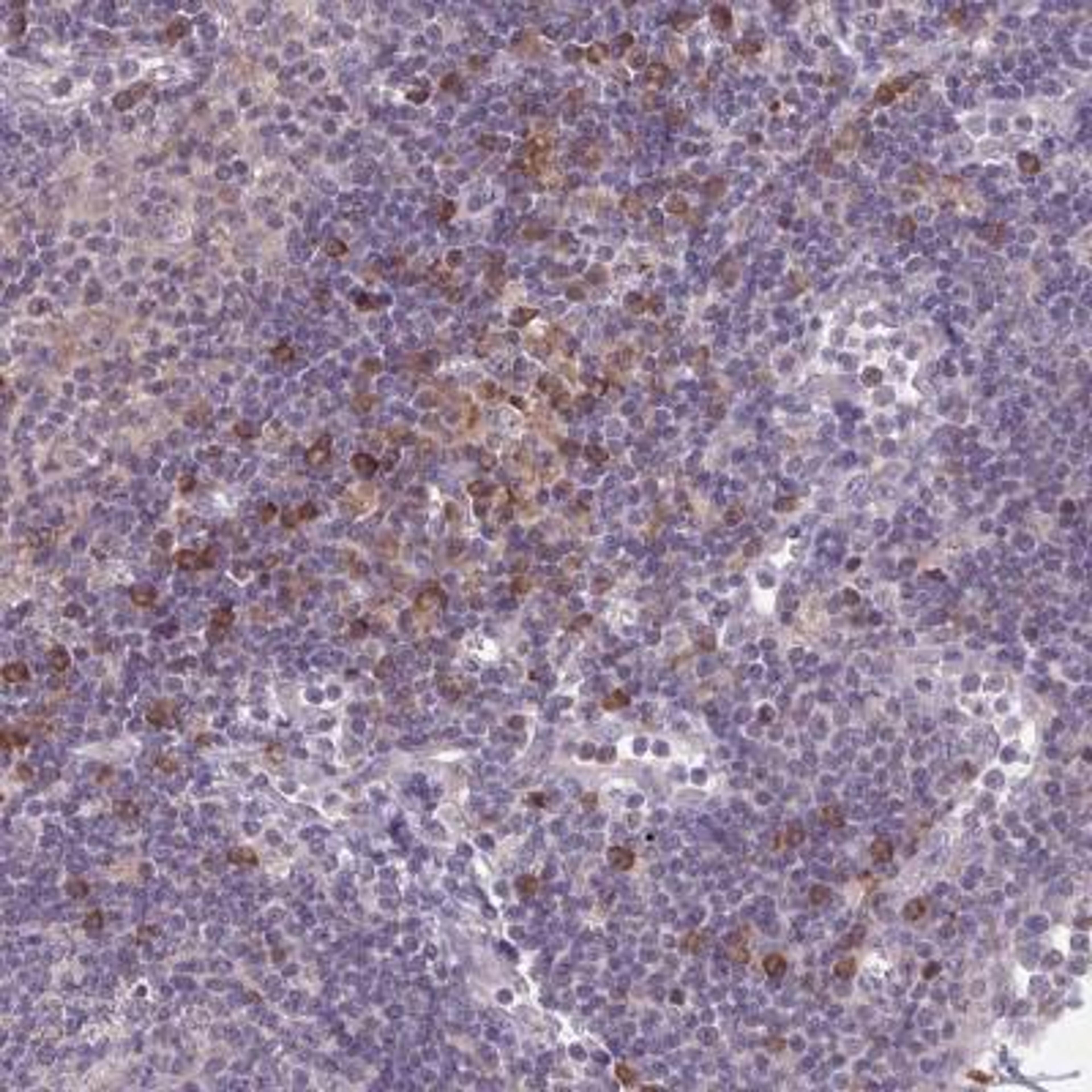 Immunohistochemistry: CD1e Antibody [NBP2-31691] - Staining of human lymph node shows moderate cytoplasmic positivity in subset of non-germinal center cells.