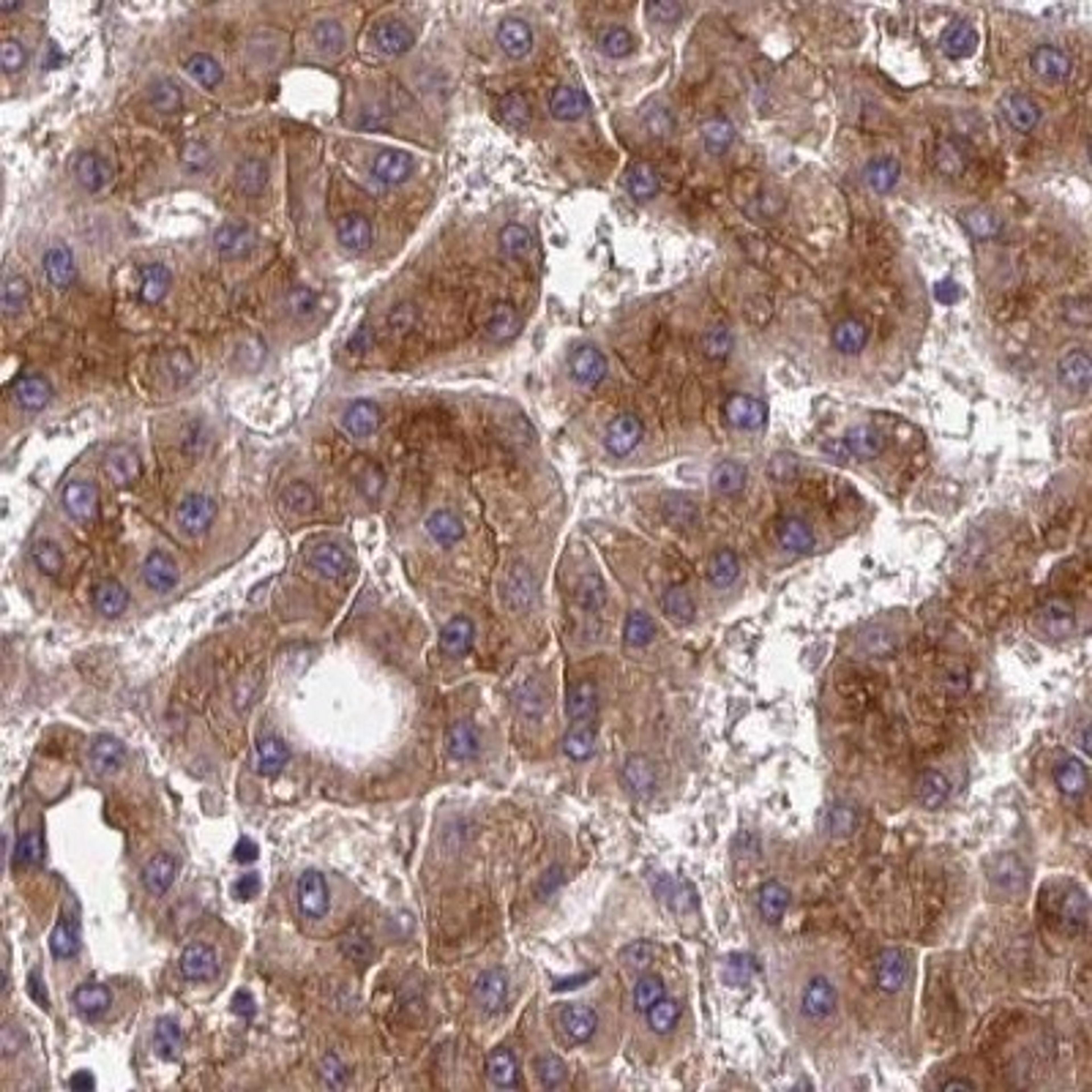 Immunohistochemistry: CYP20A1 Antibody [NBP2-31614] - liver cancer