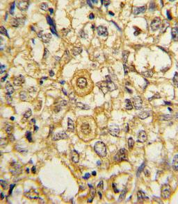 Formalin-fixed and paraffin-embedded human breast carcinoma reacted with PDGFRB Antibody (N-term), which was peroxidase-conjugated to the secondary antibody, followed by DAB staining.