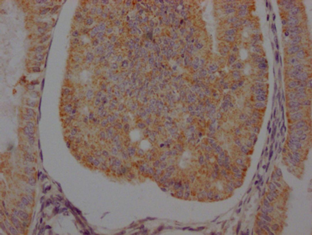 IHC image of CSB-RA286054A0HU diluted at 1:100 and staining in paraffin-embedded human endometrial cancer performed on a Leica BondTM system. After dewaxing and hydration, antigen retrieval was mediated by high pressure in a citrate buffer (pH 6.0). Section was blocked with 10% normal goat serum 30min at RT. Then primary antibody (1% BSA) was incubated at 4℃ overnight. The primary is detected by a Goat anti-rabbit IgG polymer labeled by HRP and visualized using 0.05% DAB.