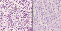 Immunohistochemistry-Paraffin: LMO4 Antibody [NBP1-19548] - Analyzes of LMO4 (E138) pAb in paraffin-embedded human tonsil carcinoma tissue at 1:50.showing cytoplasmic and nucleus staining.  Negative control (the right)Using PBS instead of primary antibody, secondary antibody is Goat Antibody