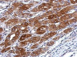 Immunohistochemistry-Paraffin: TMEM66 Antibody [NBP2-20666] - Immunohistochemical analysis of paraffin-embedded Hepatoma, using antibody at 1:500 dilution.