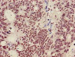 Immunohistochemistry of paraffin-embedded human colon cancer using CSB-PA010418OA36nme2HU at dilution of 1:100