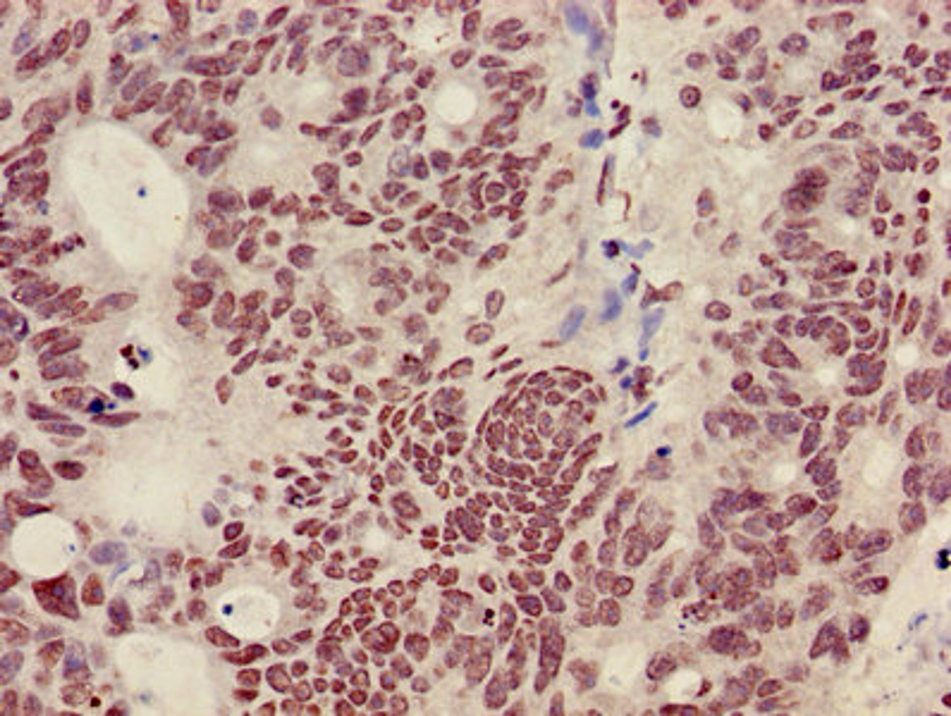 Immunohistochemistry of paraffin-embedded human colon cancer using CSB-PA010418OA36nme2HU at dilution of 1:100
