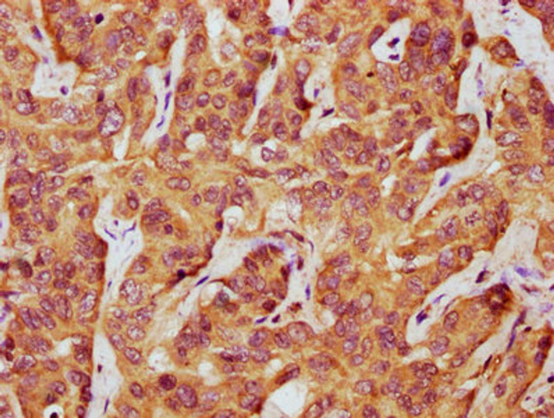 IHC image of CSB-PA012950LA01HU diluted at 1:500 and staining in paraffin-embedded human liver cancer performed on a Leica BondTM system. After dewaxing and hydration, antigen retrieval was mediated by high pressure in a citrate buffer (pH 6.0). Section was blocked with 10% normal goat serum 30min at RT. Then primary antibody (1% BSA) was incubated at 4&deg;C overnight. The primary is detected by a biotinylated secondary antibody and visualized using an HRP conjugated SP system.