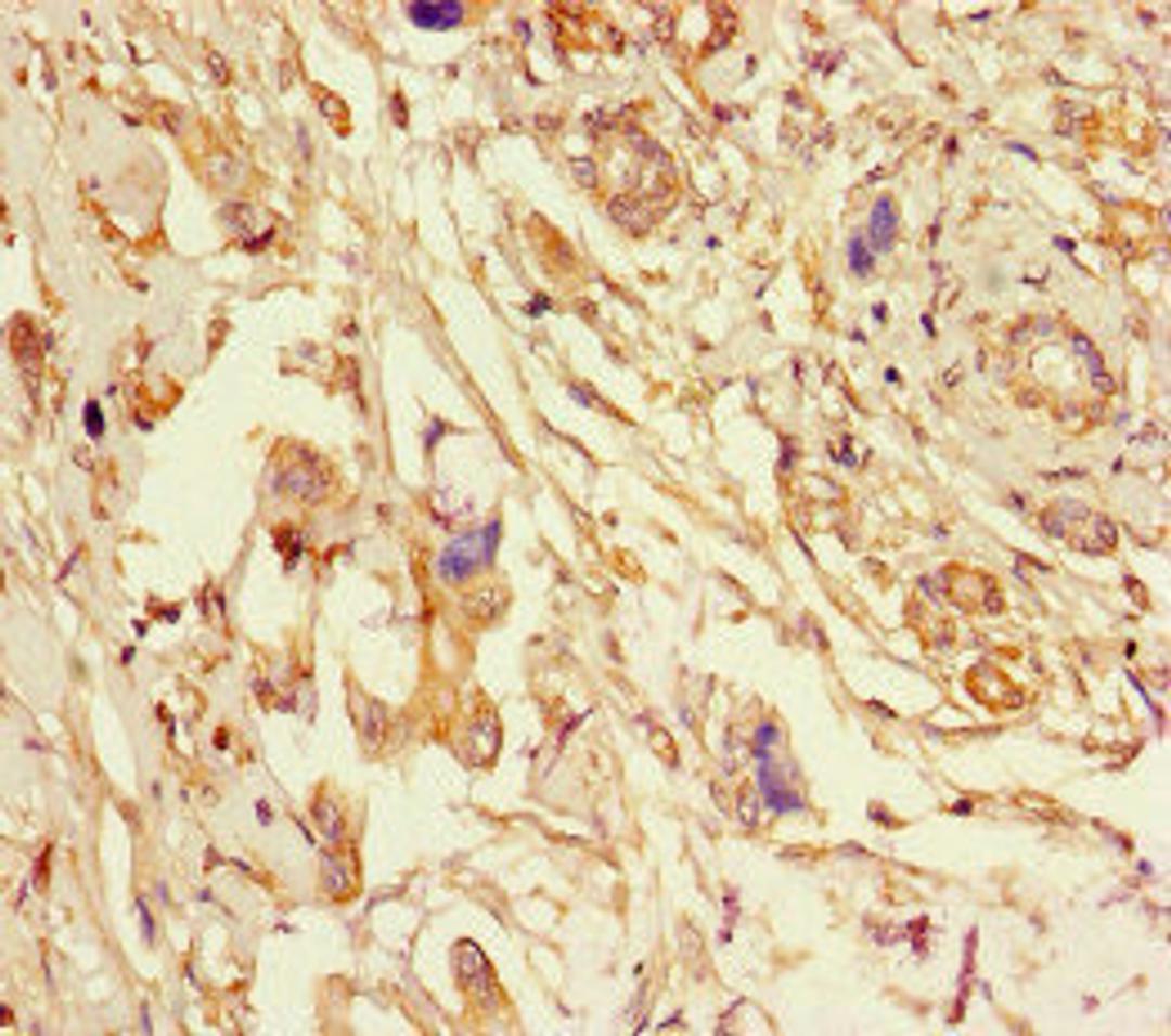 Immunohistochemistry of paraffin-embedded human pancreatic cancer using CSB-PA007791LA01HU at dilution of 1:100