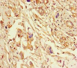 Immunohistochemistry of paraffin-embedded human pancreatic cancer using CSB-PA007791LA01HU at dilution of 1:100
