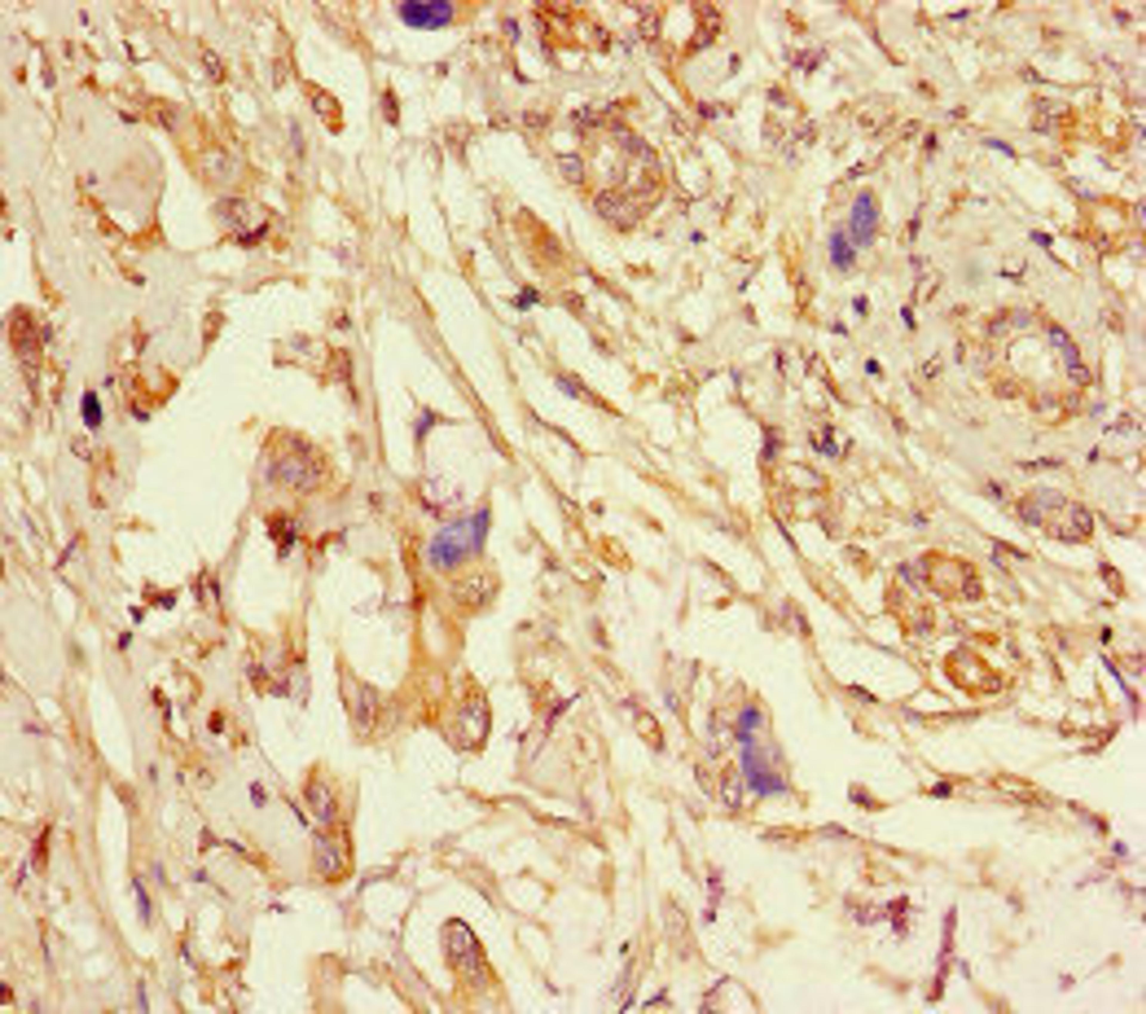 Immunohistochemistry of paraffin-embedded human pancreatic cancer using CSB-PA007791LA01HU at dilution of 1:100