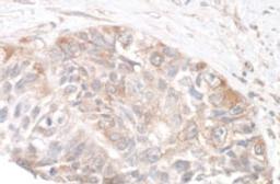 Detection of human Rictor by immunohistochemistry.