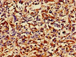 Immunohistochemistry of paraffin-embedded human melanoma using CSB-PA020595LA01HU at dilution of 1:100