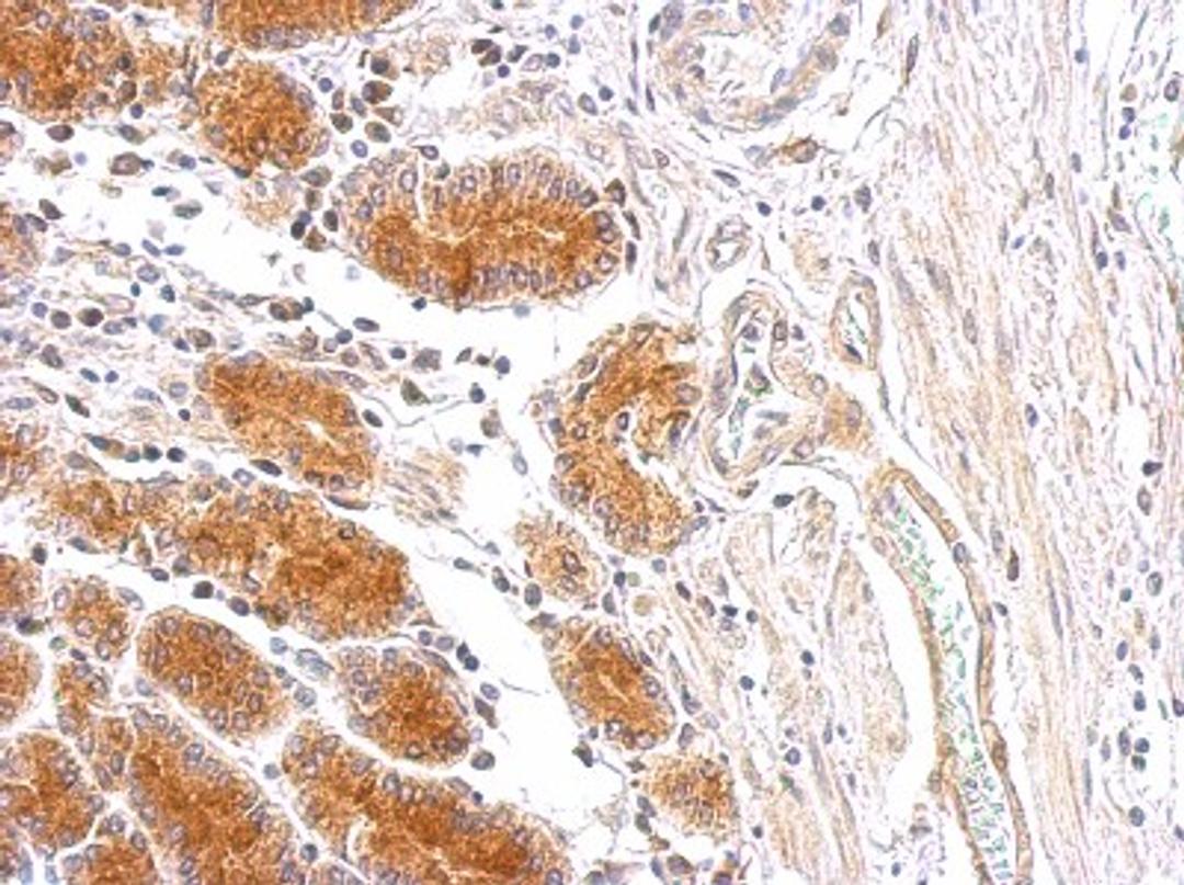 Immunohistochemistry-Paraffin: MMP28 Antibody [NBP1-33768] - Paraffin-embedded colon carcinoma tissue; antibody dilution 1:500.