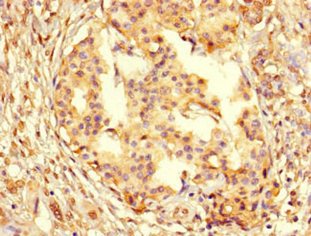 Immunohistochemistry of paraffin-embedded human pancreatic cancer using CSB-PA01567A0Rb at dilution of 1:100