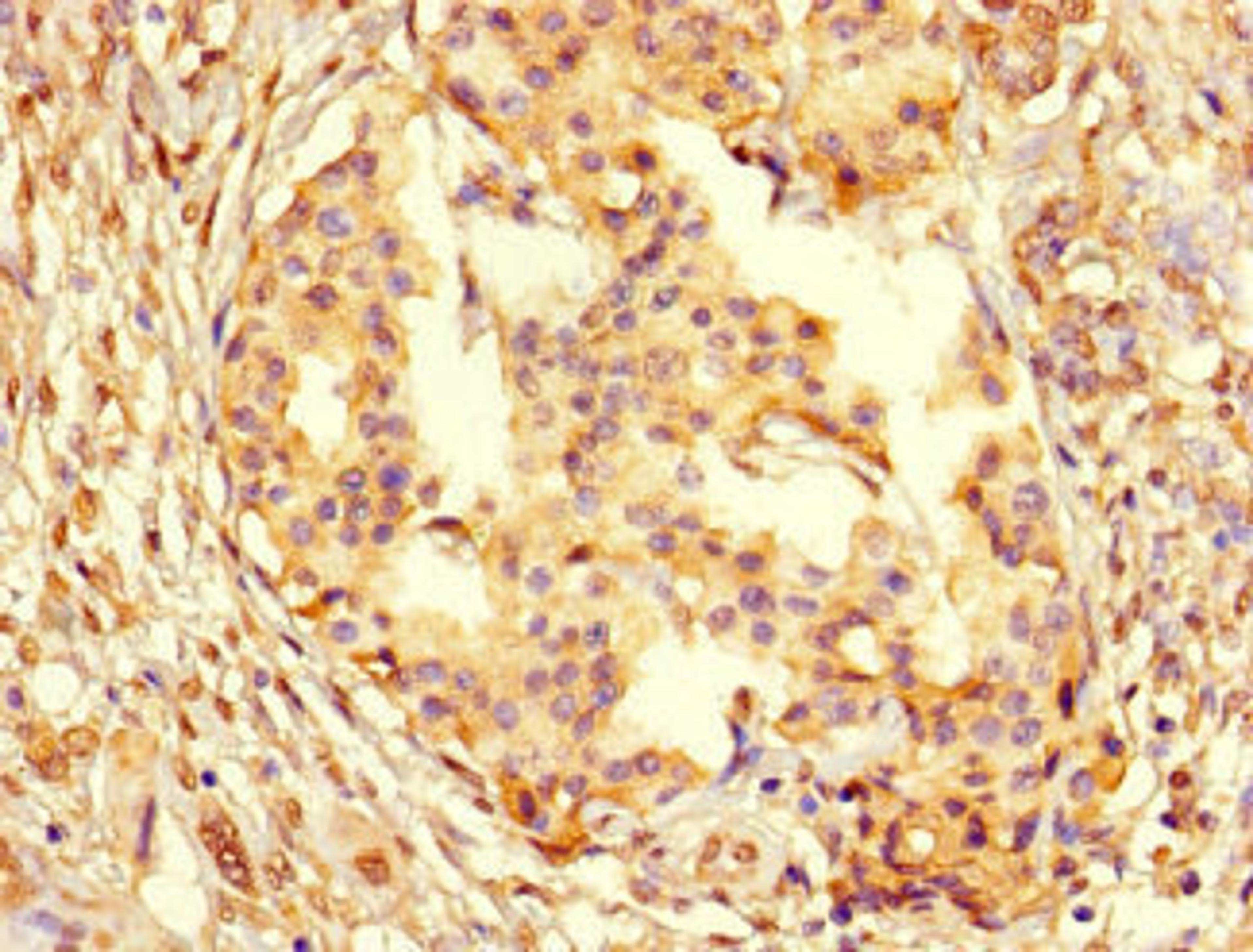 Immunohistochemistry of paraffin-embedded human pancreatic cancer using CSB-PA01567A0Rb at dilution of 1:100