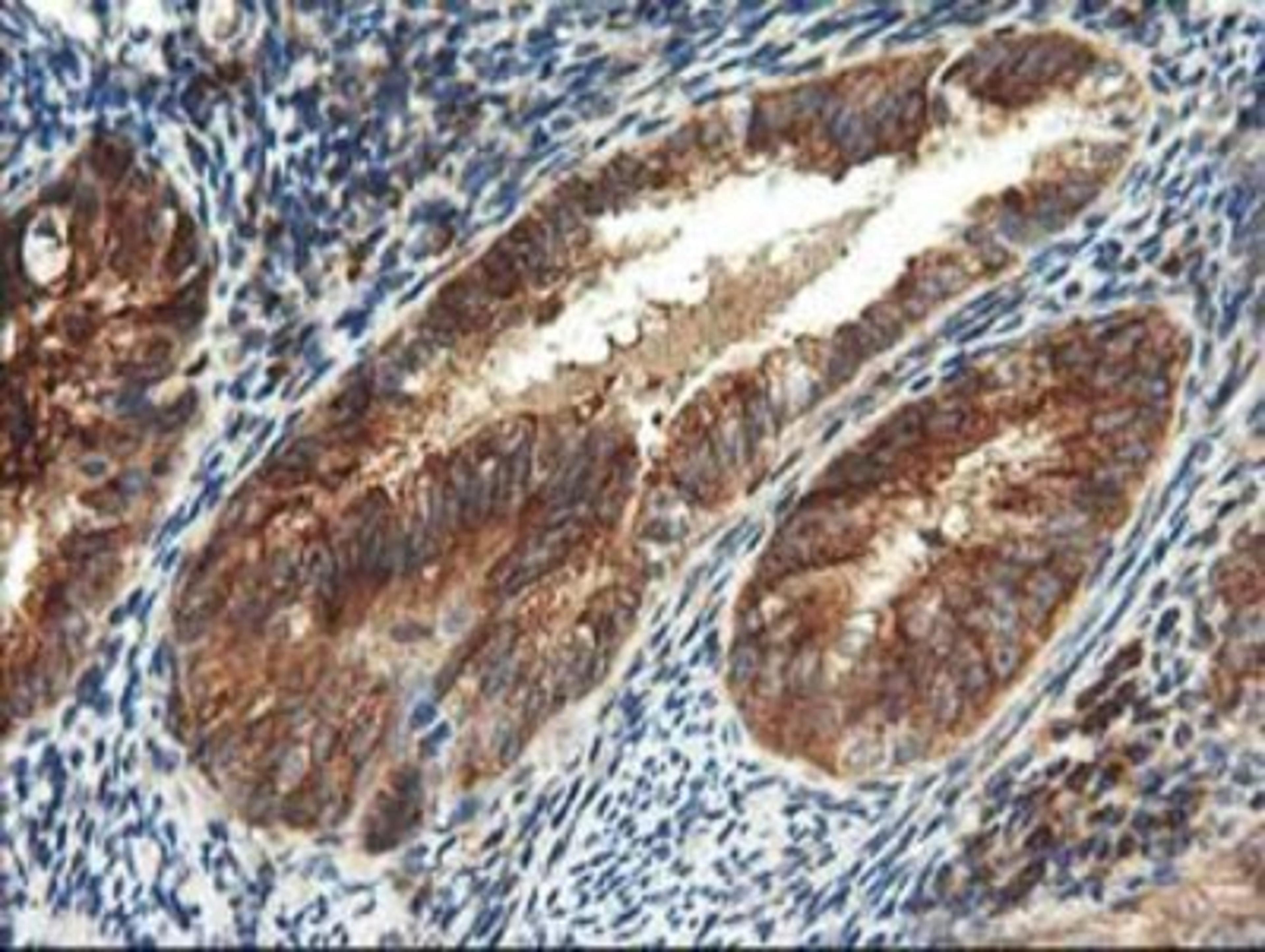 Immunohistochemistry-Paraffin: TFG Antibody (2C3) [NBP2-01438] - Staining of paraffin-embedded Adenocarcinoma of Human endometrium tissue using anti-TFG mouse monoclonal antibody.