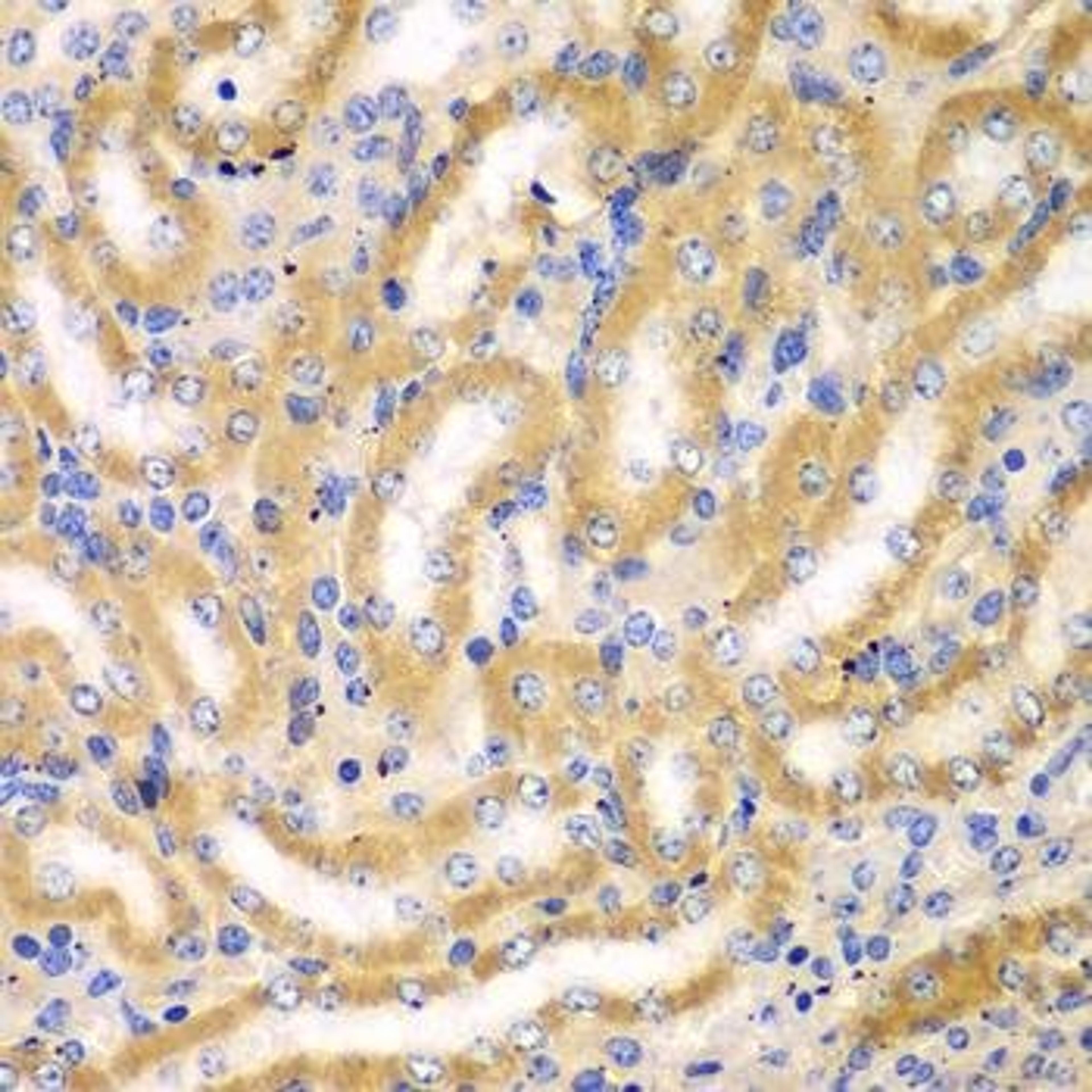 Immunohistochemical staining of human kidney cancer tissue using BCAS3 antibody (dilution of 1:100)