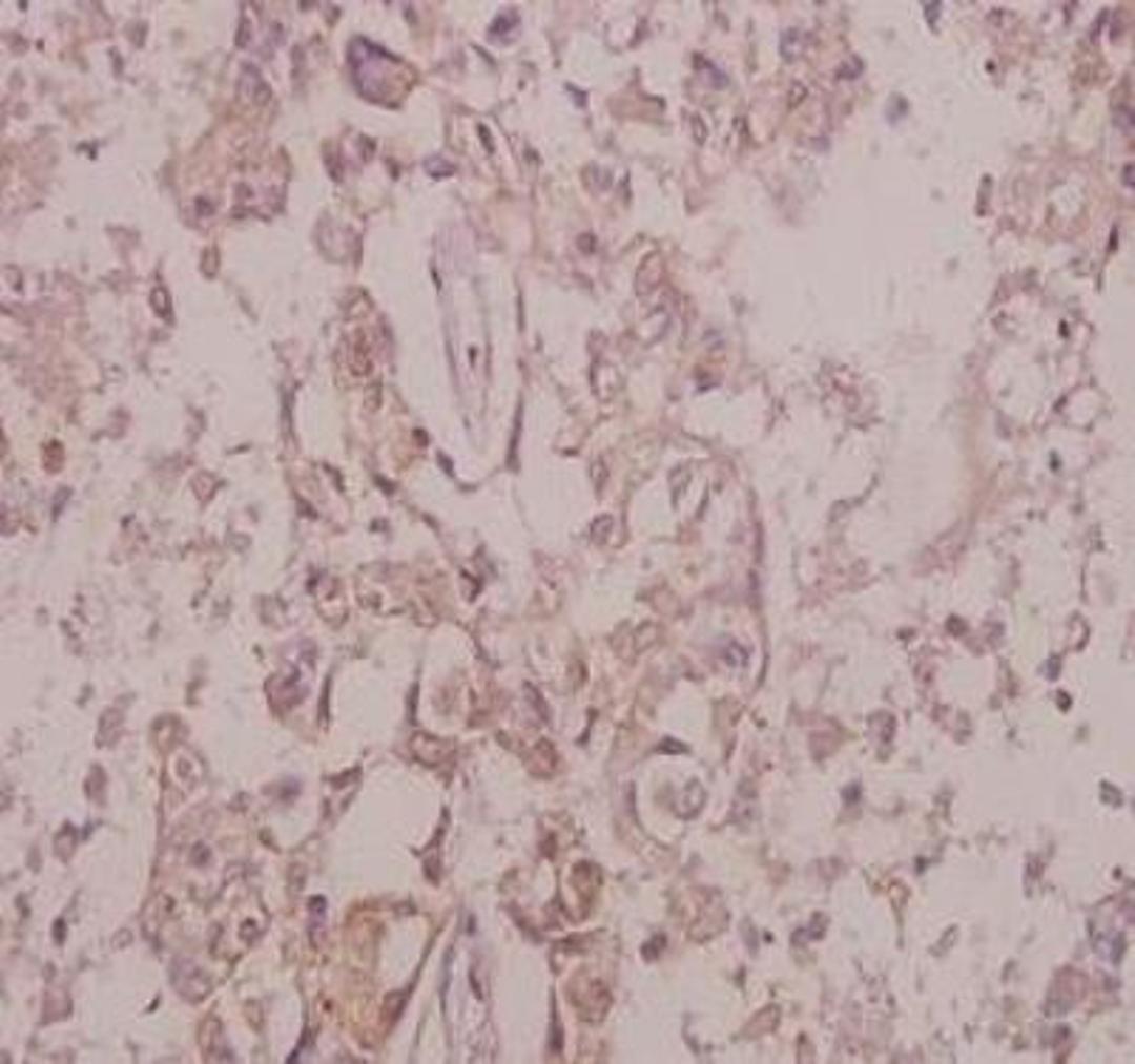 Immunohistochemistry-Paraffin: TrkB [p Tyr515] Antibody [NB100-92656] - Analysis of p-Trk B (Y515) pAb in paraffin-embedded human colorectal carcinoma tissue at 1:50.