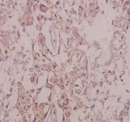 Immunohistochemistry-Paraffin: TrkB [p Tyr515] Antibody [NB100-92656] - Analysis of p-Trk B (Y515) pAb in paraffin-embedded human colorectal carcinoma tissue at 1:50.