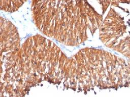 Immunohistochemical staining of human Bladder carcinoma tissue using HSPD1 antibody