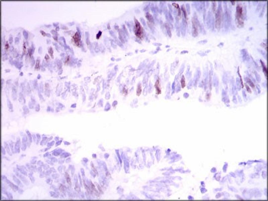 Immunohistochemistry: INCENP Antibody (3D2) [NBP2-37471] - Immunohistochemical analysis of paraffin-embedded rectum cancer tissues using INCENP mouse mAb with DAB staining.