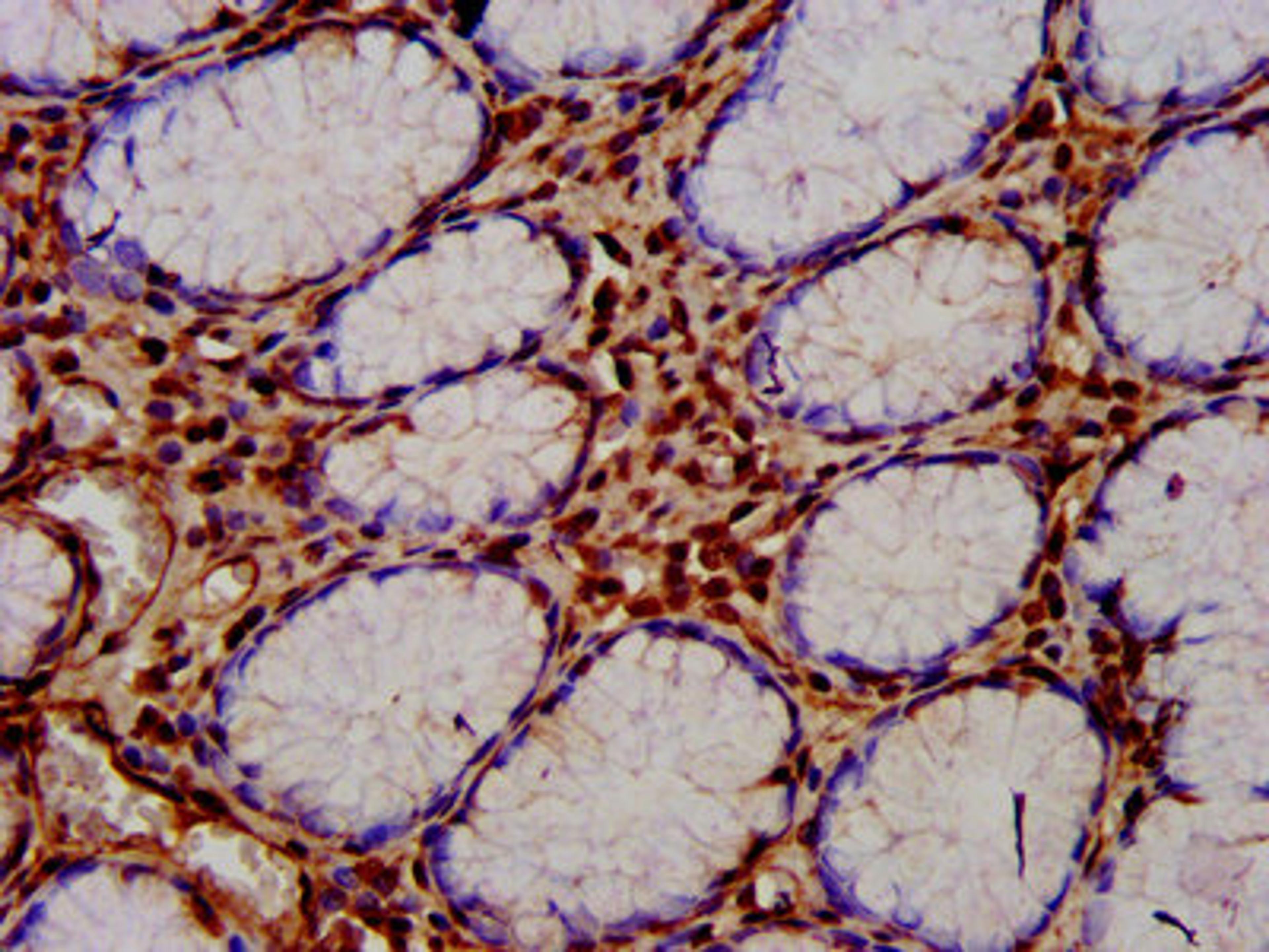 IHC image of CSB-PA873651LA01HU diluted at 1:400 and staining in paraffin-embedded human gastric cancer performed on a Leica BondTM system. After dewaxing and hydration, antigen retrieval was mediated by high pressure in a citrate buffer (pH 6.0). Section was blocked with 10% normal goat serum 30min at RT. Then primary antibody (1% BSA) was incubated at 4&deg;C overnight. The primary is detected by a biotinylated secondary antibody and visualized using an HRP conjugated SP system.