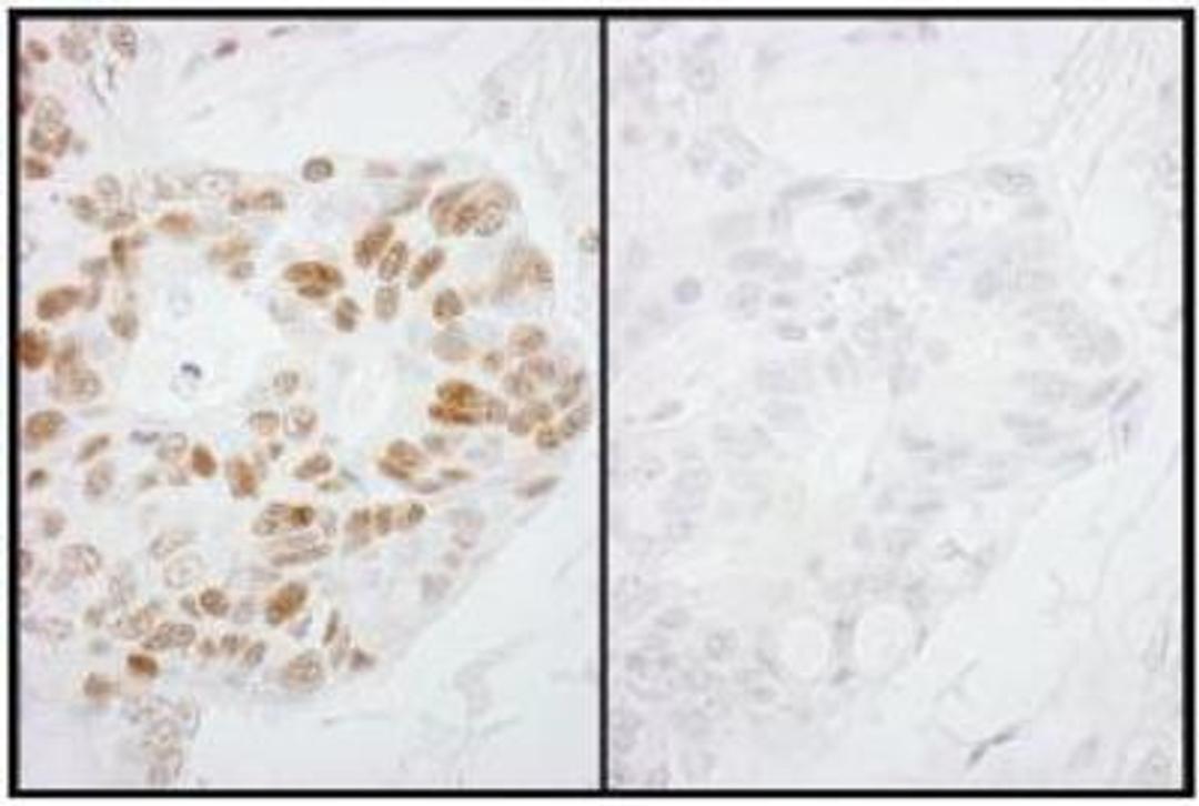 Immunohistochemistry-Paraffin: RNA Polymerase II/POLR2A [p Ser2] Antibody [NB100-1805] - Detection of Human Phospho-RNA Polymerase II (S2) by Immunohistochemistry. Samples: FFPE serial sections of human ovarian carcinoma. Mock phosphatase treated section (left) or calf intestinal phosphatase-treated section (right) immunostained for Phospho-RNA Polymerase II (S2). Antibody: Affinity purified rabbit anti-Phospho-RNA Polymerase II (S2) used at a dilution of 1:250. Detection: DAB staining using Immunohistochemistry Accessory Kit.