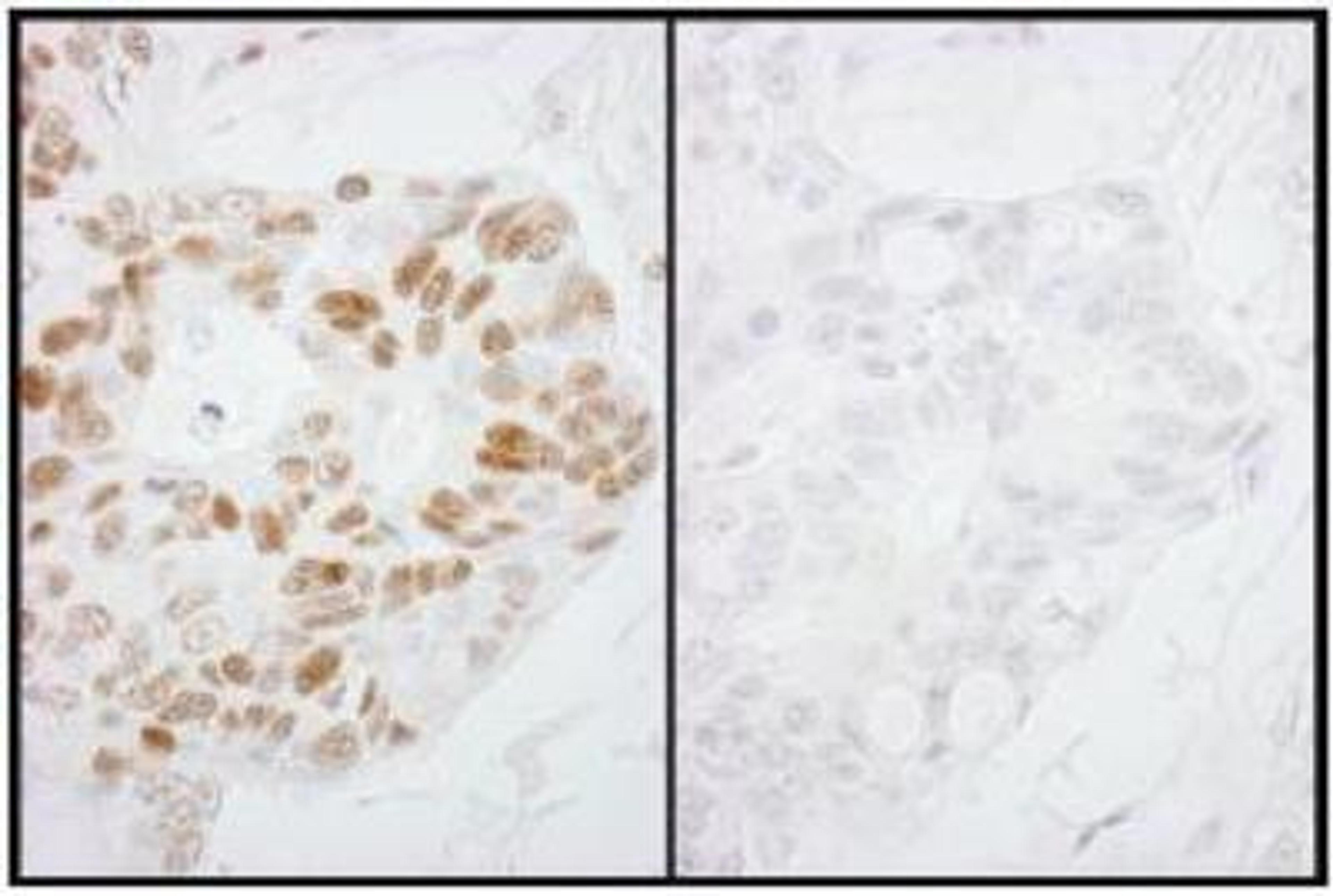 Immunohistochemistry-Paraffin: RNA Polymerase II/POLR2A [p Ser2] Antibody [NB100-1805] - Detection of Human Phospho-RNA Polymerase II (S2) by Immunohistochemistry. Samples: FFPE serial sections of human ovarian carcinoma. Mock phosphatase treated section (left) or calf intestinal phosphatase-treated section (right) immunostained for Phospho-RNA Polymerase II (S2). Antibody: Affinity purified rabbit anti-Phospho-RNA Polymerase II (S2) used at a dilution of 1:250. Detection: DAB staining using Immunohistochemistry Accessory Kit.