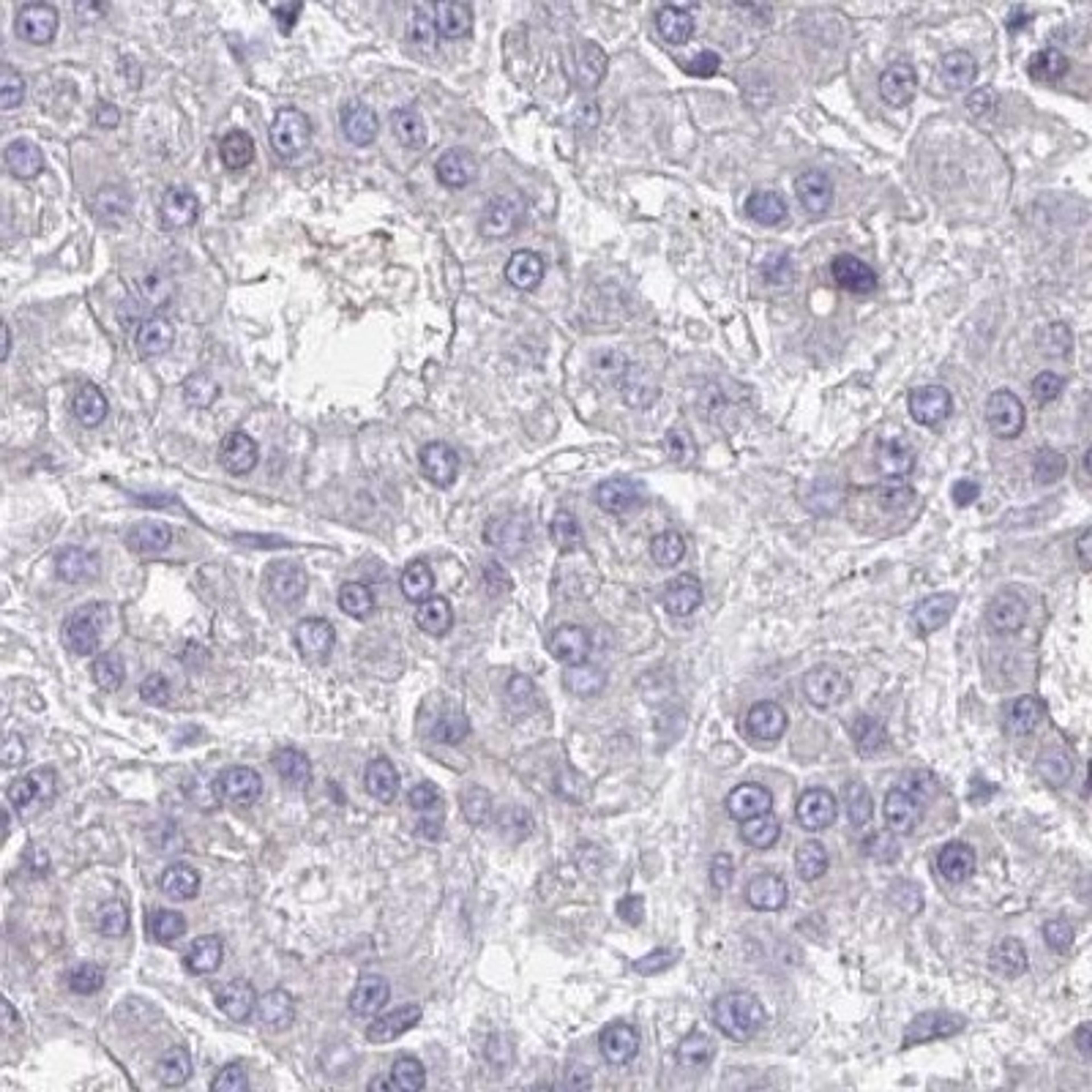 Immunohistochemistry: OR4X2 Antibody [NBP2-31810] - liver cancer