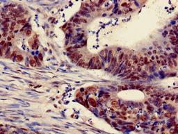 Immunohistochemistry of paraffin-embedded human colon cancer using CSB-PA010418PA18nacHU at dilution of 1:100