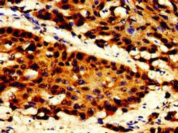 Immunohistochemistry of paraffin-embedded human cervical cancer using CSB-PA717547LA01HU at dilution of 1:100
