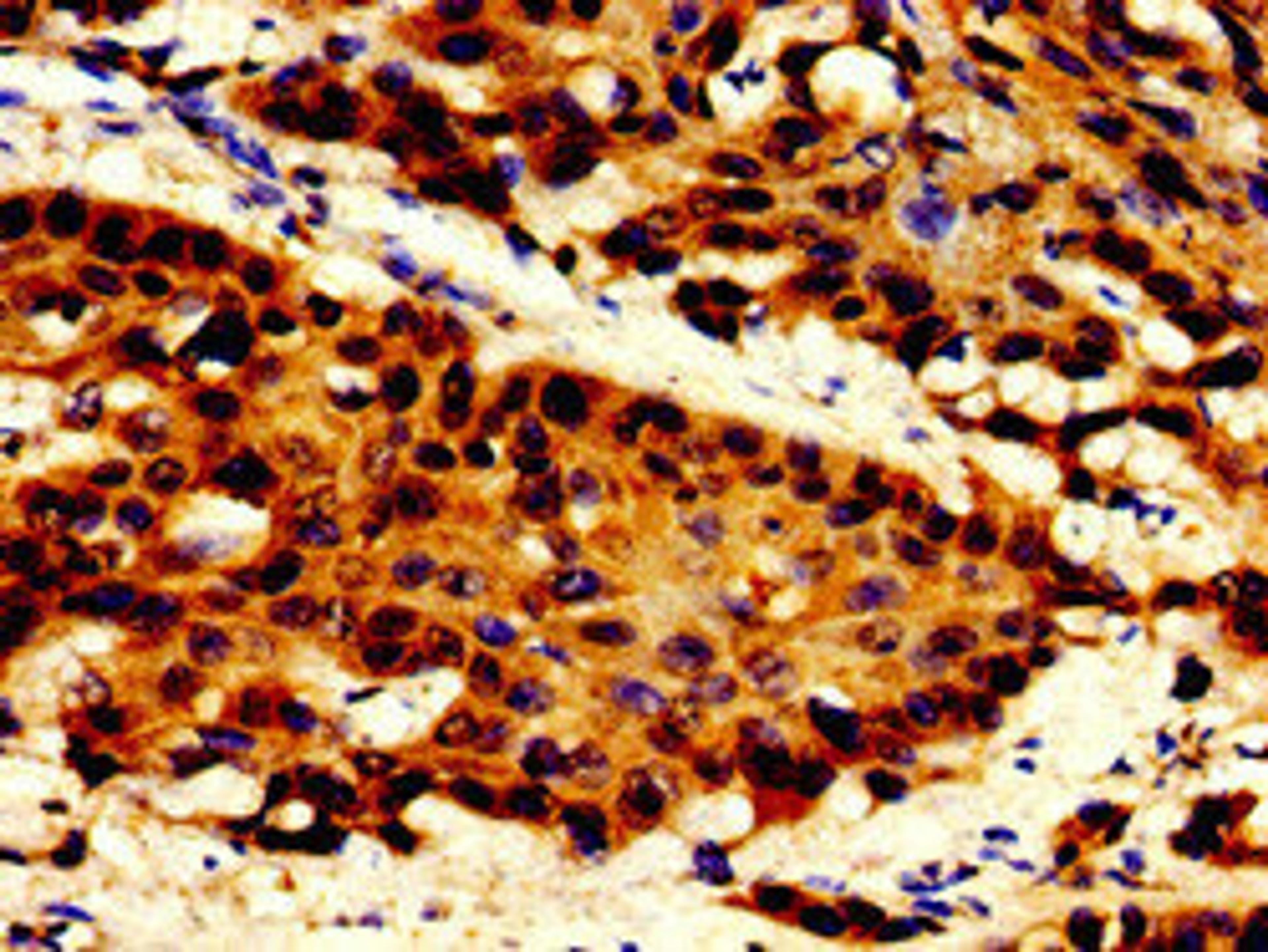 Immunohistochemistry of paraffin-embedded human cervical cancer using CSB-PA717547LA01HU at dilution of 1:100