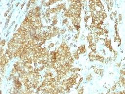 Formalin-fixed, paraffin-embedded human breast carcinoma stained with GRP94 antibody (HSP90B1/1192).