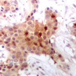 Immunohistochemical staining of human breast cancer tissue using SMN1; SMN2 antibody