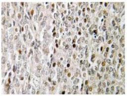 Immunohistochemistry-Paraffin: FOXE3 Antibody [NBP1-19594] - Immunohistochemistry (IHC) analyzes of FoxE3 (R97) pAb in paraffin-embedded human prostate carcinoma tissue.