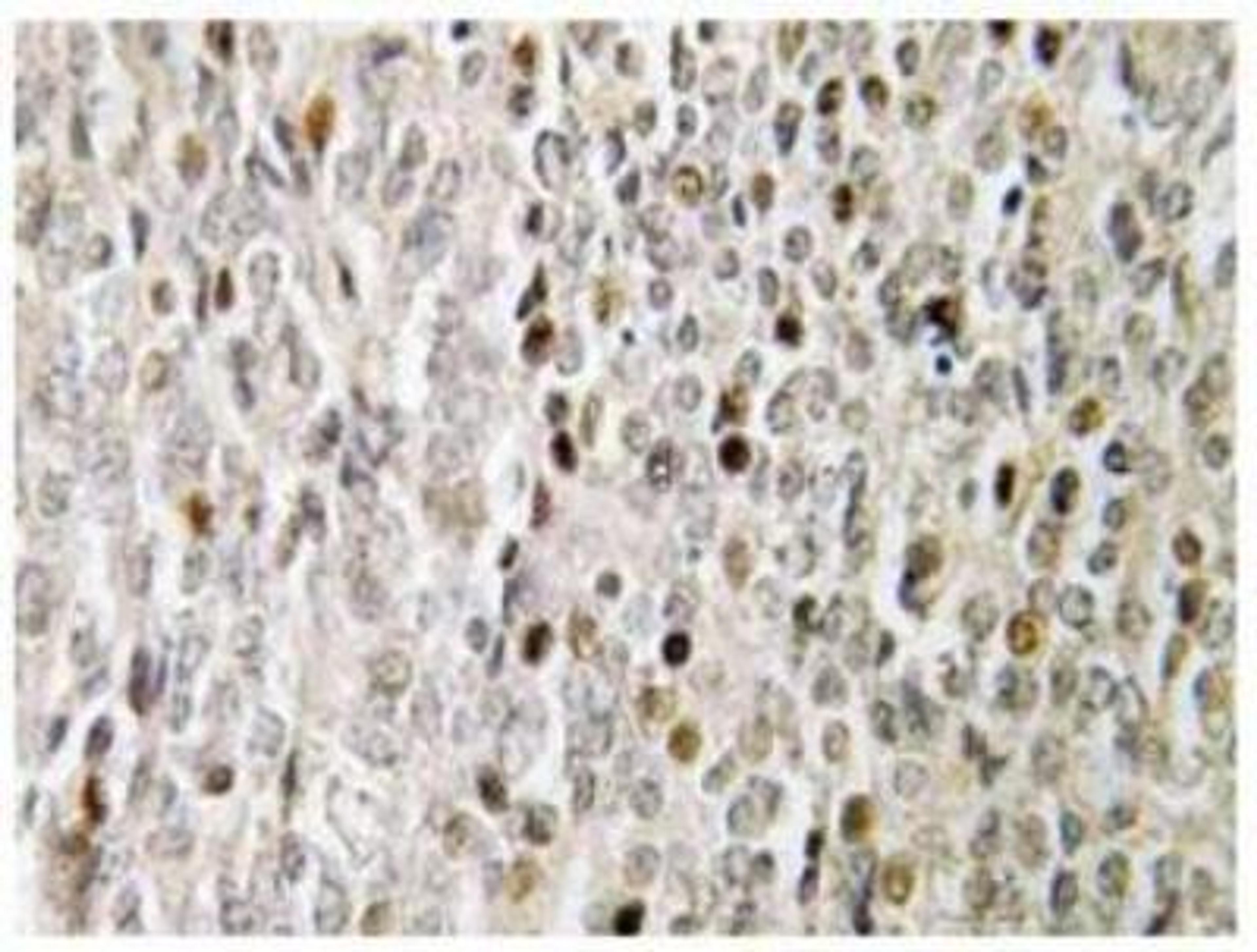 Immunohistochemistry-Paraffin: FOXE3 Antibody [NBP1-19594] - Immunohistochemistry (IHC) analyzes of FoxE3 (R97) pAb in paraffin-embedded human prostate carcinoma tissue.