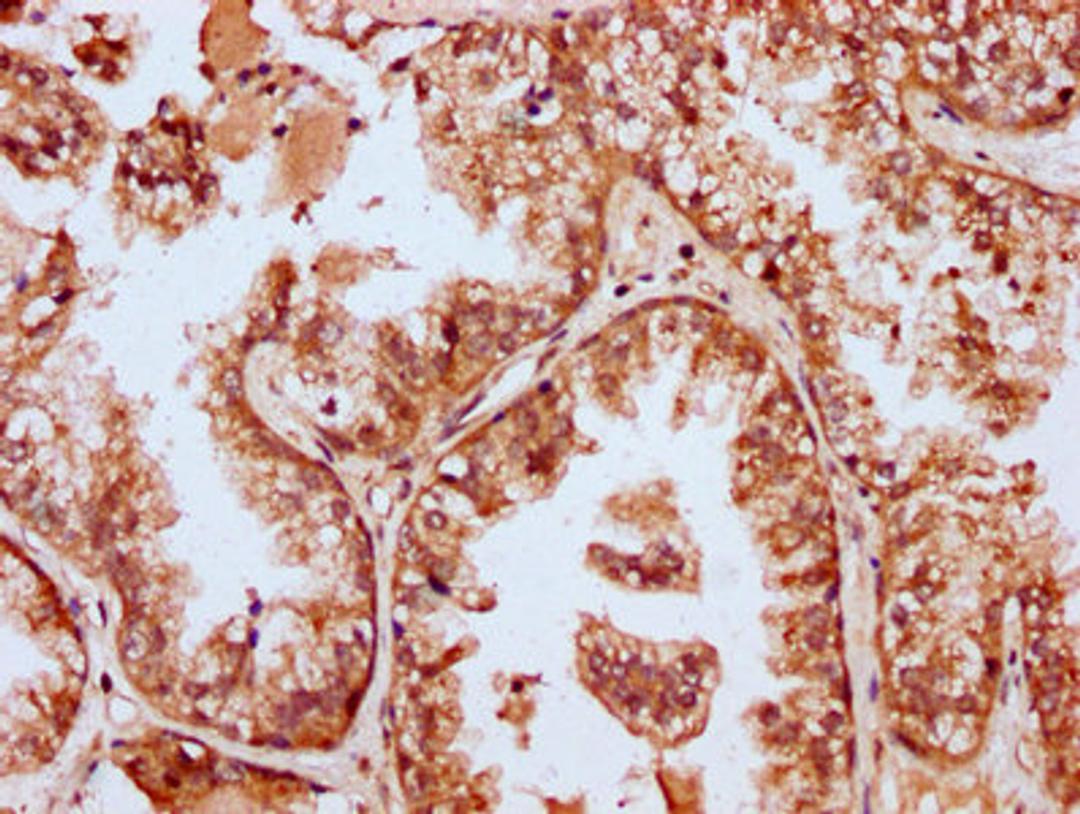 IHC image of CSB-PA868322LA01HU diluted at 1:400 and staining in paraffin-embedded human prostate cancer performed on a Leica BondTM system. After dewaxing and hydration, antigen retrieval was mediated by high pressure in a citrate buffer (pH 6.0). Section was blocked with 10% normal goat serum 30min at RT. Then primary antibody (1% BSA) was incubated at 4&deg;C overnight. The primary is detected by a biotinylated secondary antibody and visualized using an HRP conjugated SP system.