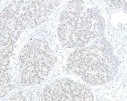 Detection of human HJURP by immunohistochemistry. Sample: FFPE section of human lung carcinoma.