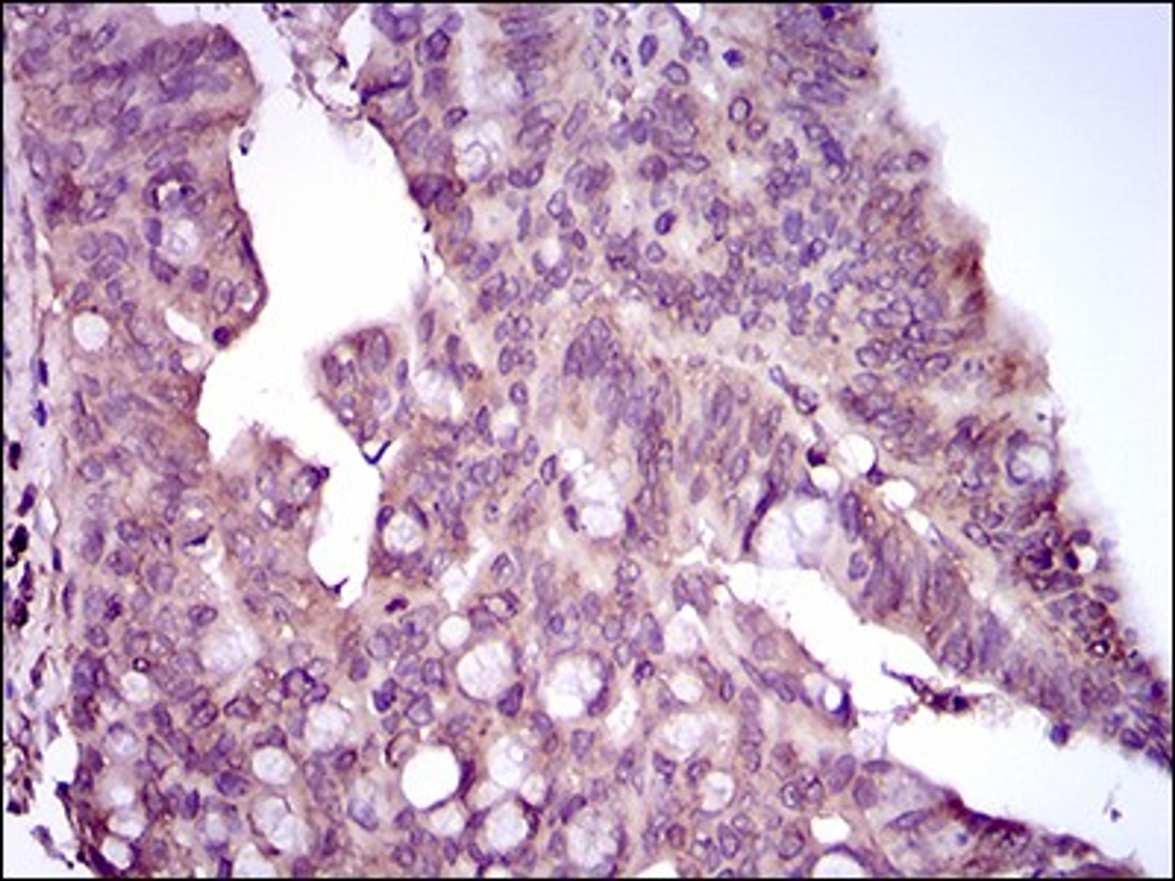 Immunohistochemistry: p38 Antibody (8G4D11) [NBP2-37378] - Immunohistochemical analysis of paraffin-embedded rectum cancer tissues using MAPK14 mouse mAb with DAB staining.