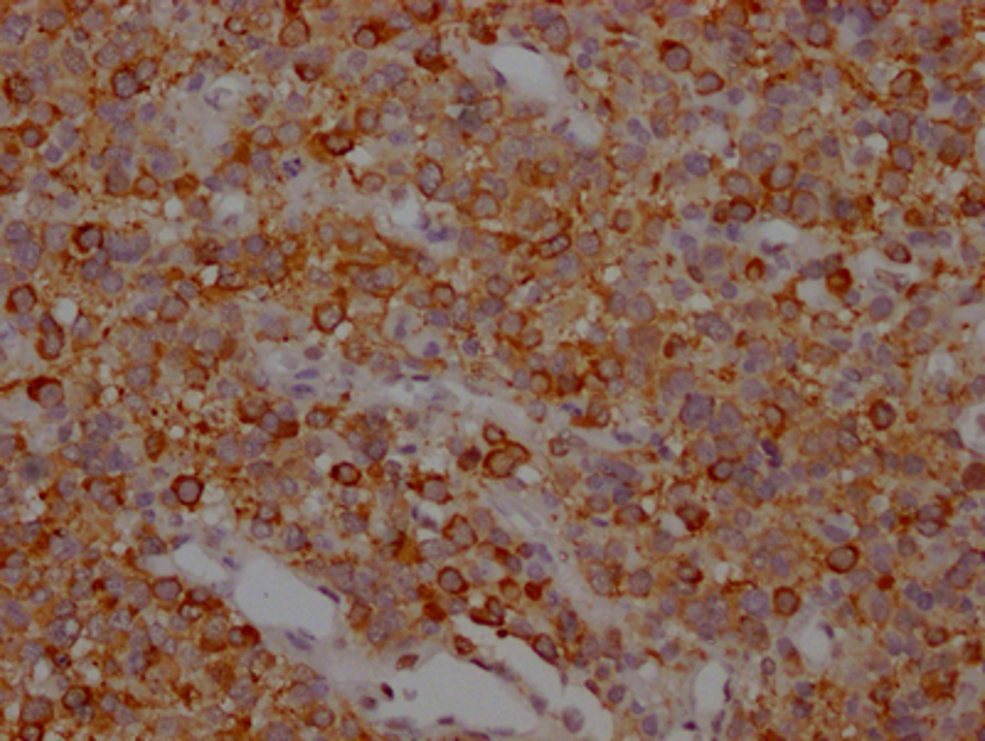 IHC image of CSB-RA246354A0HU diluted at 1:100 and staining in paraffin-embedded human glioma cancer performed on a Leica BondTM system. After dewaxing and hydration, antigen retrieval was mediated by high pressure in a citrate buffer (pH 6.0). Section was blocked with 10% normal goat serum 30min at RT. Then primary antibody (1% BSA) was incubated at 4℃ overnight. The primary is detected by a Goat anti-rabbit IgG polymer labeled by HRP and visualized using 0.05% DAB.