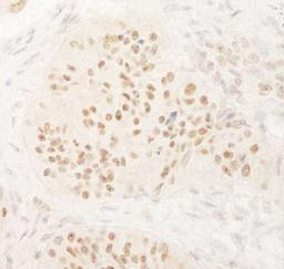 Immunohistochemistry-Paraffin: KIFC1 Antibody [NB100-40844] - Human ovarian carcinoma.   Antibody used  at a dilution of 1:5,000 (0.2ug/ml).