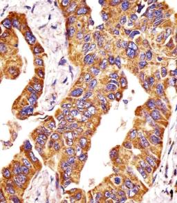 Antibody staining MMP14 in human lung adenocarcinoma tissue sections by Immunohistochemistry (IHC-P - paraformaldehyde-fixed, paraffin-embedded sections).