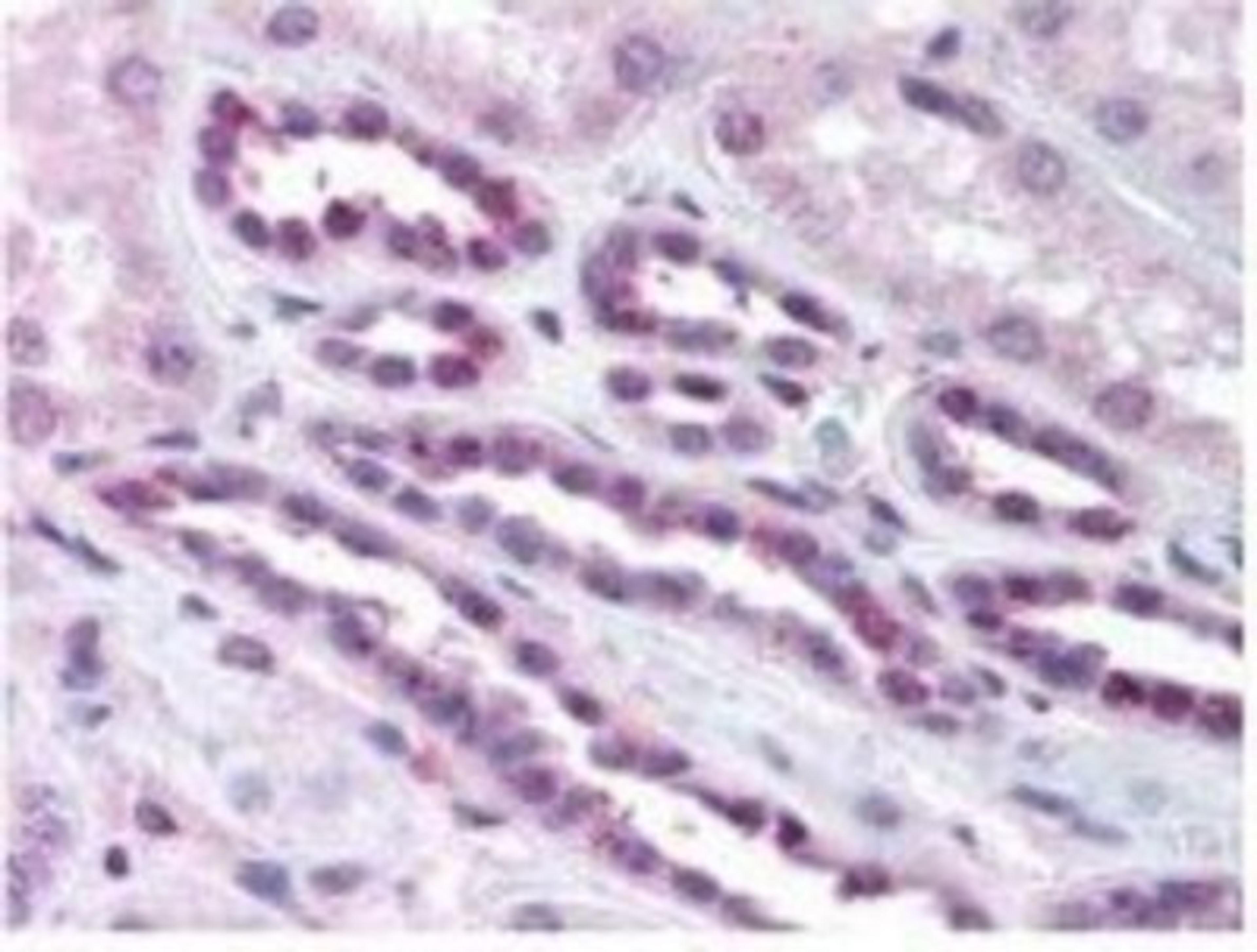 Immunohistochemistry-Paraffin: RelA/NFkB p65 [p Ser529] Antibody [NBP1-77808] - pS276 shows phospho p65 staining in carcinoma cells.