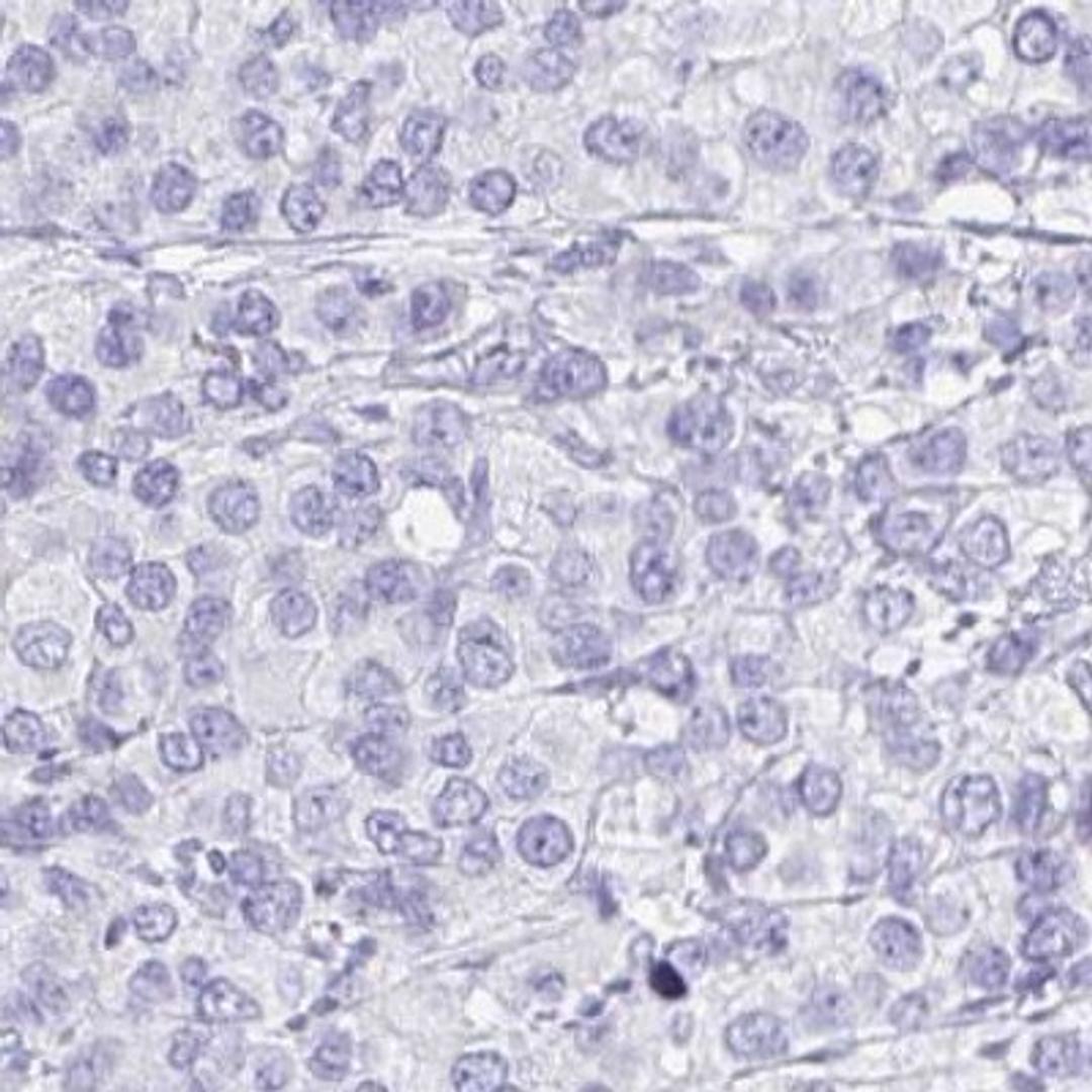 Immunohistochemistry: C4orf17 Antibody [NBP2-31831] - breast cancer