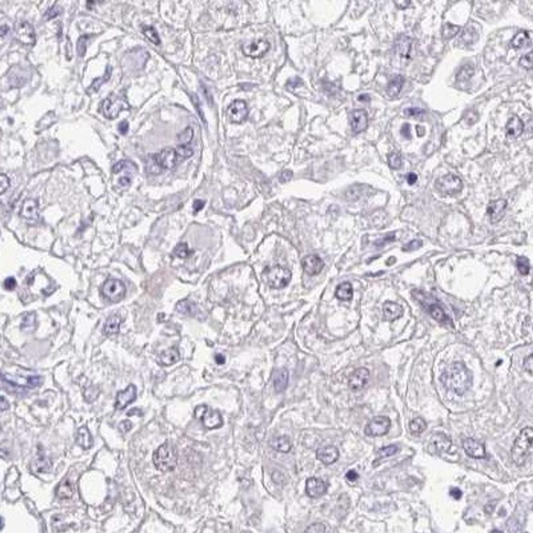 Immunohistochemistry: ZNF485 Antibody [NBP2-32451] - liver cancer