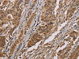 The image on the left is immunohistochemistry of paraffin-embedded Human gastic cancer tissue using CSB-PA047746(COX6B1 Antibody) at dilution 1/50, on the right is treated with fusion protein. (Original magnification: ×200)