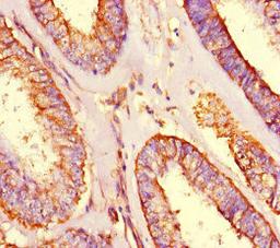 Immunohistochemistry of paraffin-embedded human endometrial cancer using CSB-PA844740LA01HU at dilution of 1:100