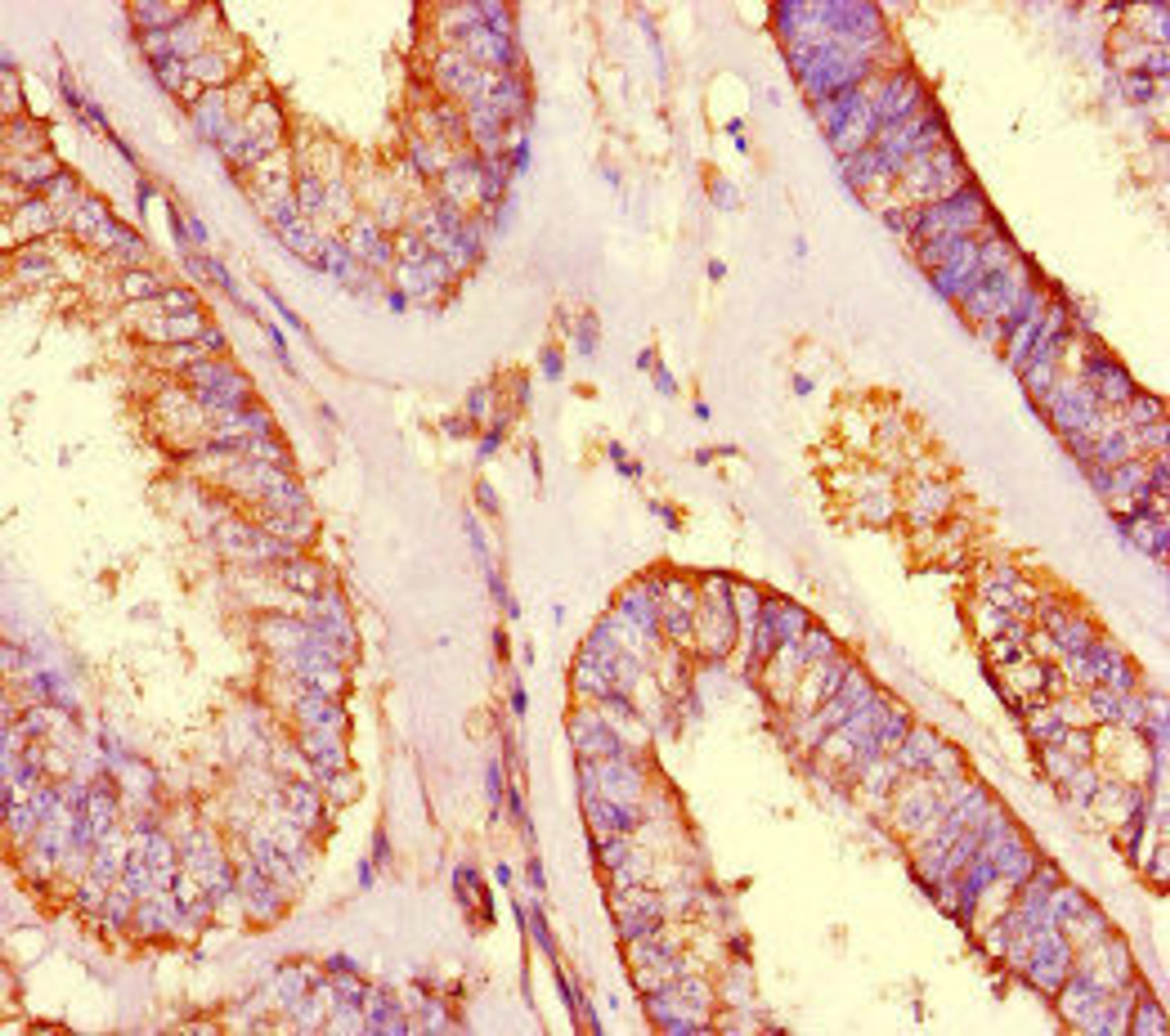 Immunohistochemistry of paraffin-embedded human endometrial cancer using CSB-PA844740LA01HU at dilution of 1:100