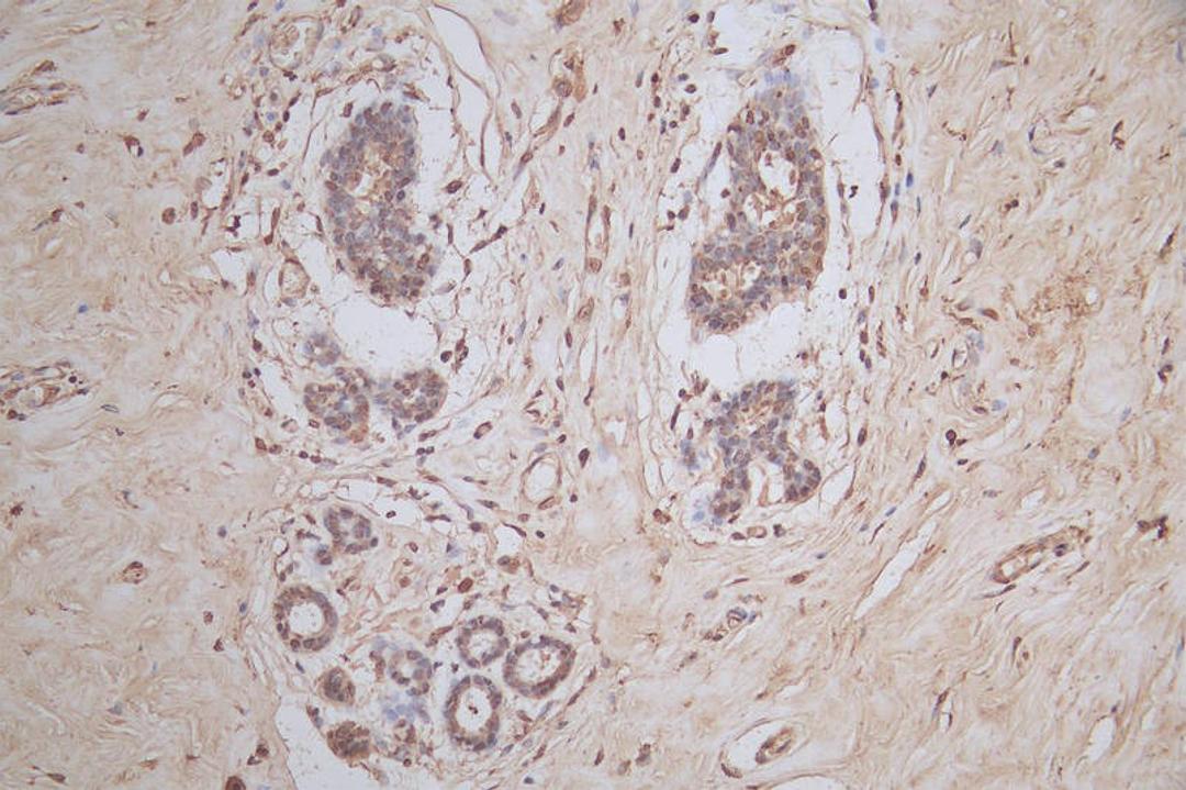IHC image of CSB-RA022332MA1HU diluted at 1:50 and staining in paraffin-embedded human breast tissue performed on a Leica BondTM system. After dewaxing and hydration,  antigen retrieval was mediated by high pressure in a citrate buffer (pH 6.0). Section was blocked with 10% normal goat serum 30min at RT. Then primary antibody (1% BSA) was incubated at 4°C overnight. The primary is detected by a Goat anti-mouse polymer IgG labeled by HRP and visualized using 0.05% DAB.
